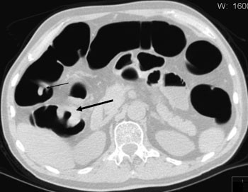 Figur 2  Pasient henvist til CT-kolografi etter inkomplett koloskopi grunnet en strikturerende prosess. Dette var en tumor,&hellip;