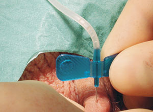 Figur 4  Perkutan spermieaspirasjon (percutaneous sperm aspiration, PESA). S&aelig;dv&aelig;ske fra bitestikkelen aspireres ved hjelp av&hellip;