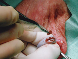 Figur 5 Testikul&aelig;r spermieekstraksjon (testicular sperm extraction, TESE). Ved en &aring;pen operasjon hentes testikkelvev for&hellip;