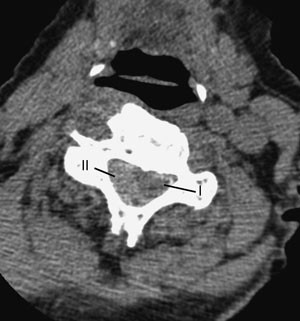 Figur 2  CT etter myelografi. Svak lys kontrastrand rundt ryggmargen (I), som ligger klemt mot venstre av det lysere&hellip;
