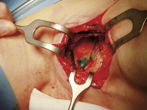 To bl&aring;fargede lymfebaner som konvergerer mot en stor, bl&aring;farget vaktpostlymfeknute i armhulen