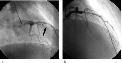Figur 2  a) Koronar angiografi viste generelle veggforandringer samt 90&thinsp;% stenose i midtre LAD. b) Denne ble PCI-behandlet&hellip;