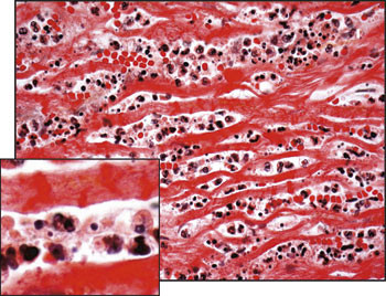 Figur 4  Histologisk preparat som til sammenlikning viser akutt hjerteinfarkt. Det er rikelig infiltrasjon av granulocytter&hellip;