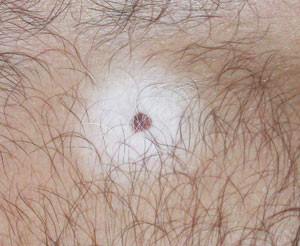 Figur 2  Halo nevus. Vi ser en sentralt beliggende pigmentf&oslash;flekk omsluttet av depigmentert hud. Merk de hvite h&aring;rene