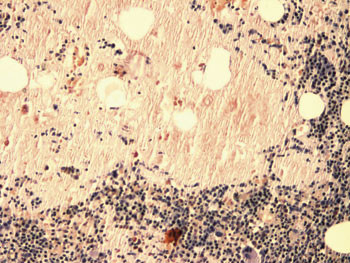 Figur 5  Beinmargsbiopsi. Kongofarging for amyloid