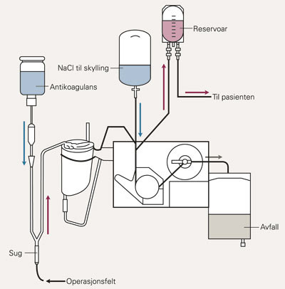 &laquo;Cellsaver&raquo;. Blod fra operasjonen tilsettes heparin og aspireres til &laquo;cellsaver&raquo;-systemet. Her vaskes antikoagulerte&hellip;