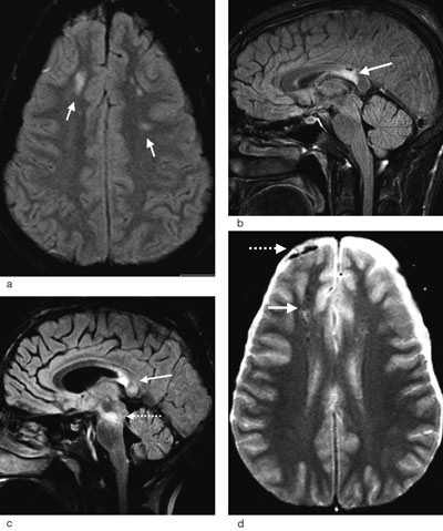 Figur 2  a) Diffus aksonal skade grad 1. MR-bilde i transversalplanet med FLAIR-sekvens som viser lesjoner i hvitsubstansen&hellip;