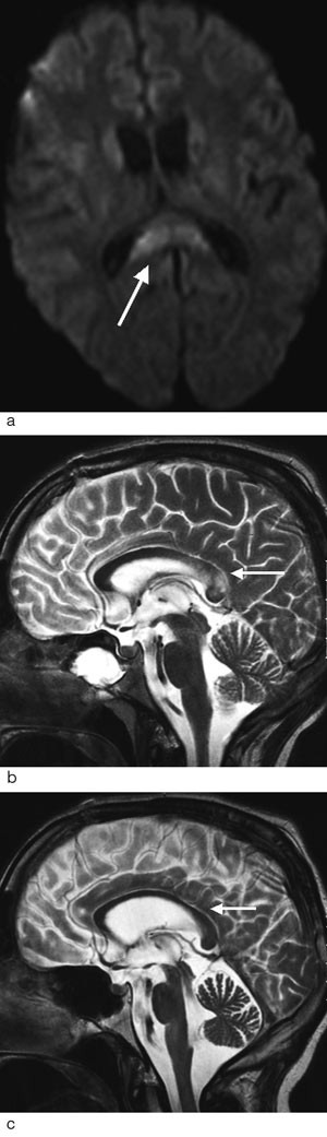 Figur 3  Pasient med GCS-sk&aring;r 4 og h&oslash;yenergiskade etter front-mot-front-kollisjon. Forandringer p&aring; diffusjonsbilder i&hellip;