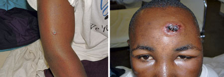 Til venstre bryllupsgjest med antrakss&aring;r p&aring; armen. Noen dager senere kom han som hadde slaktet kua, til klinikken med et&hellip;