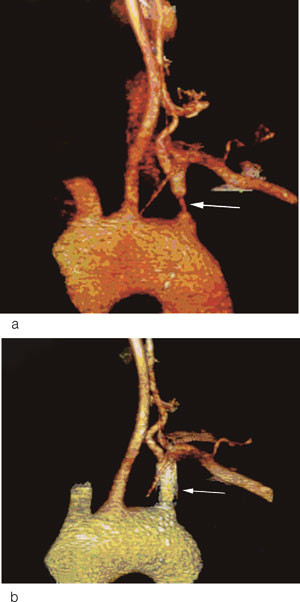 Figur 2  a) Tredimensjonal CT-angiografi f&oslash;r stentinnleggelse. Det ses en h&oslash;ygradig stenose proksimalt i venstre a&hellip;