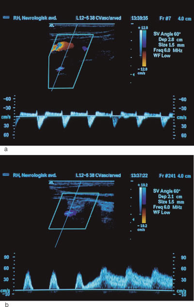 Figur 3  a) Ultralyd av a. vertebralis i hvilesituasjon. Ustabil hemodynamikk i arterien med retrograd blodstr&oslash;m i systolen&hellip;