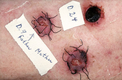 Figur 5  &laquo;Tredjemannstest&raquo; for &aring; finne ut om mor eller far passet best som nyregiver til sin s&oslash;nn. D. 24: Avst&oslash;tt hudlapp&hellip;