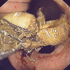 Figur 2  Deler av b&aring;ndet er klippet