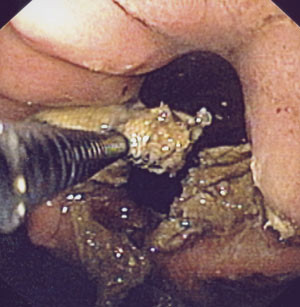 Figur 3  B&aring;ndet er klippet over