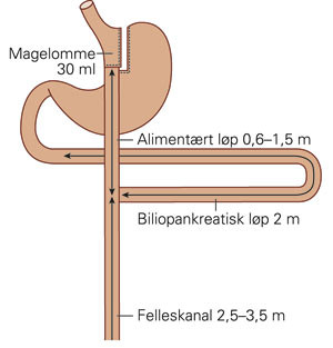 Roux Y gastrisk bypass med langt biliopankreatisk l&oslash;p