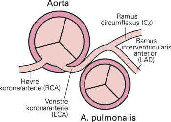 Pasient 2. Aorta- og pulmonalostiet med avgangen av koronararteriene sett ovenfra