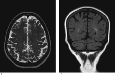 Figur 2  MR-bildene. a) Aksial T2 og b) koronal FLAIR tatt fire m&aring;neder etter symptomdebut viser full tilbakegang av&hellip;