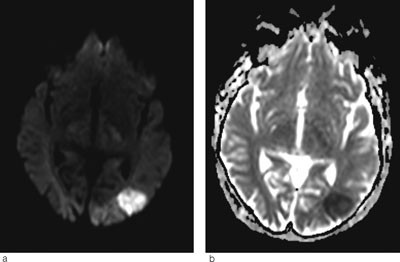 Figur 3  MR-bildene viser a) diffusjonsvektet sekvens og b) ADC-kart hos en annen pasient med hjerneinfarkt i samme omr&aring;de&hellip;