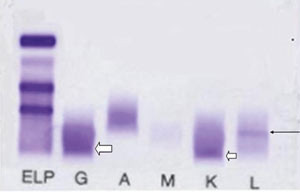 Figur 2  Serumimmunfiksasjonselektroforese. P&aring;visning av sm&aring; mengder av komplett IgG-&kappa; katodisk i &gamma;&thinsp;-sonen (&lArr;) og&hellip;