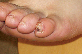 Figur 3  Neglefibrom