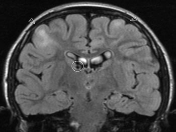 Figur 4  Cerebral MR: Koronal T2-FLAIR. Kortikale tubera og subependymal knute. Foto Radiologisk avdeling, S&oslash;rlandet sykehus&hellip;