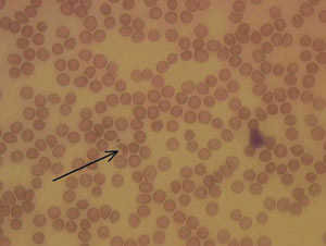 Figur 2  I dette blodutstryket er en schistocytt med typisk utseende markert med pil. Schistocytter kan forekomme n&aring;r&hellip;