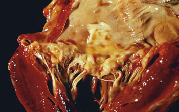 Figur 2  Sklerose i mitralklaff. Foto &copy; Science Photo Library/GV-Press