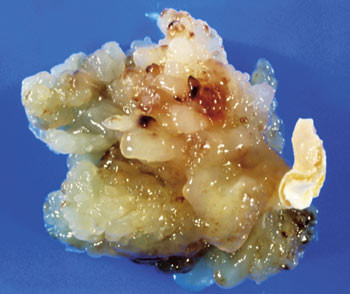 Figur 3  Myksom fra venstre atrium. Foto &copy; Dr. E. Walker, Science Photo Library/GV-Press