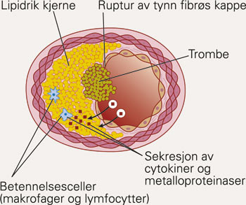 Viktige karakteristika ved det ustabile plakk