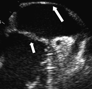 Figur 3  Siden lydhodet (transduseren) st&aring;r rett bak venstre atrium ved trans&oslash;sofageal ekkokardiograf, kan vi f&aring; sv&aelig;rt klare&hellip;