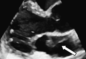 Figur 4   Parasternal langakseavbildning med transtorakal tredimensjonal ekkokardiografi (Vivid 7, GE Vingmed). Membranen i&hellip;
