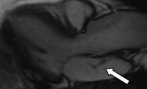 Figur 5  MR-bilde tilsvarende det ekkokardiografiske langakseplanet. Membranen i venstre atrium er merket med pil