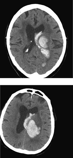 Figur 2  CT caput tatt henholdsvis tre timer og ni timer etter debut av symptomer hos 82 &aring;r gammel mann med akutt&hellip;