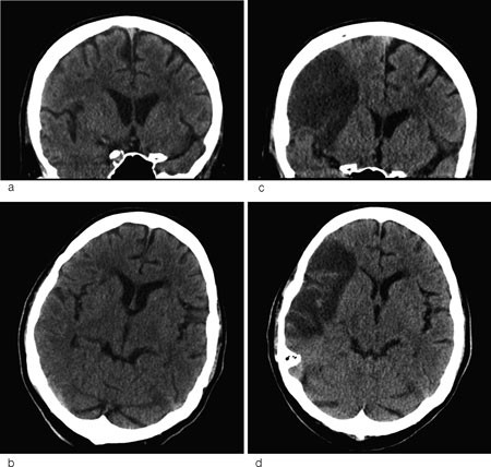 Figur 2  Cerebral CT i a) koronalplan og b) horisontalplan ved innleggelse er tilsynelatende normal, men inneholder et&hellip;