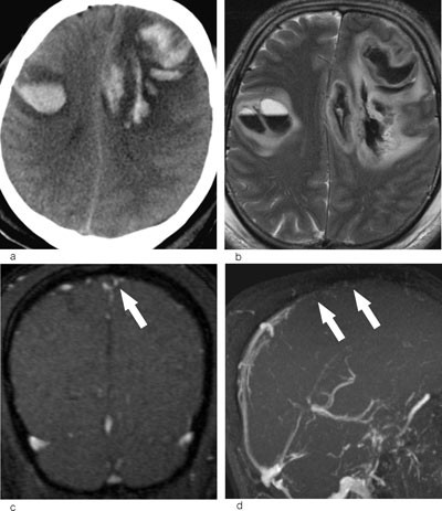 Figur 3  a) CT caput viser bilaterale hemoragier, forenlig med hemoragiske infarkter. b) T2-vektet MR-bilde av samme pasient&hellip;