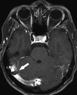 Figur 4  T1-vektet bilde i transversalplan etter intraven&oslash;s kontrast viser en Pacchioni-granulasjon i typisk lokalisasjon i&hellip;