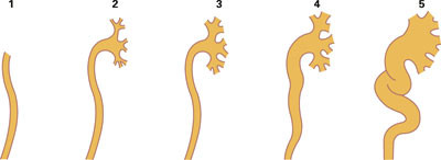 Gradering av vesikoureteral refluks etter International Reflux Study Committee (7)