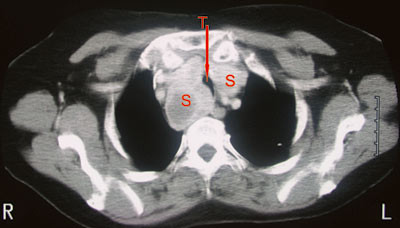 Figur 2  CT av &oslash;vre thorax hos pasient 1. Trachea er komprimert til ca. 1 cm x 0,6 cm. Kaudalt for strumaet m&aring;ler trachea ca&hellip;
