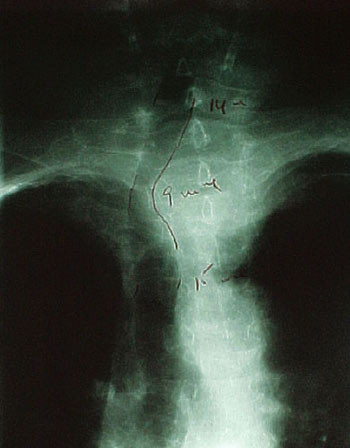 Figur 3  R&oslash;ntgen thorax hos samme pasient som i figur 1 viser intratorakalt struma med tracheadeviasjon og moderat&hellip;