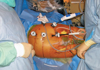 Figur 2  Pasient i h&oslash;yre sideleie. Plassering av trokar i bukveggen under laparoskopisk aortakirurgi