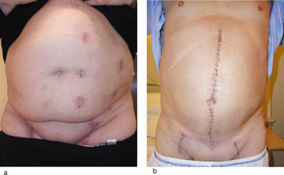 Figur 3  Arr etter a) total laparoskopisk og b) &aring;pen aortobifemoral bypass