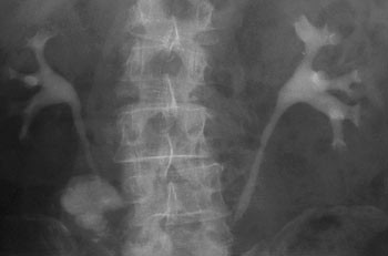 Figur 3  15-minutters bilde som viser normale funn halvannen m&aring;ned etter operasjonen