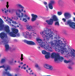 Figur 3  Autopsifunn ved Chagas&rsquo; kardiomyopati med amastigote former (svarte piler) og intracellul&aelig;re trypanosomstadier &hellip;
