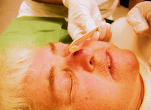 Figur 2  Krem inneholdende det aktive stoffet metylaminolevulinat p&aring;f&oslash;res svulstomr&aring;det i et tynt lag