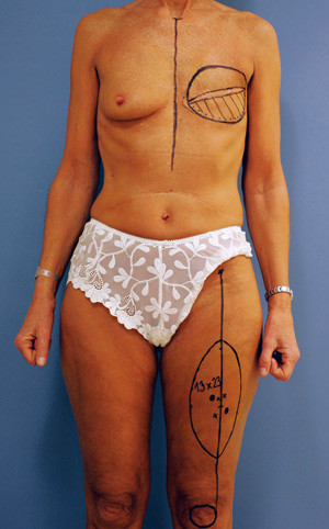 Figur 2   55 &aring;r gammel kvinne etter venstresidig mastektomi. Det kontralaterale bryst er lite. L&aring;rets omfang er relativt&hellip;