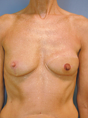 Figur 5  Sluttresultat etter ytterligere rekonstruksjon av areolamamillekompleks med lokal lapp og tatovering samt&hellip;