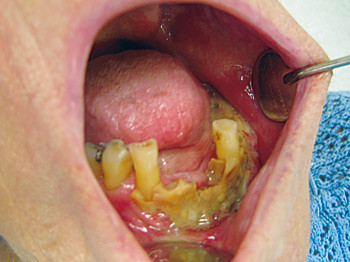Figur 2  Osteonekrose i underkjeven hos en 94 &aring;r gammel kvinne som i over 20 &aring;r var behandlet med alendronsyre (Fosamax) mot&hellip;