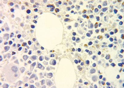 Figur 2  Immunhistokjemisk farging av beinmargsbiopsi hvor lymfocytter positive for &lambda;-kjeder er godt synlige til h&oslash;yre og&hellip;