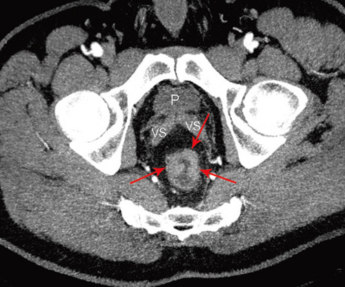 Figur 2  Multidetektor-CT av rectumcancer. Rekonstruksjon perpendikul&aelig;rt p&aring; tumors lengdeakse. (Piler: tumor, P: prostata,&hellip;