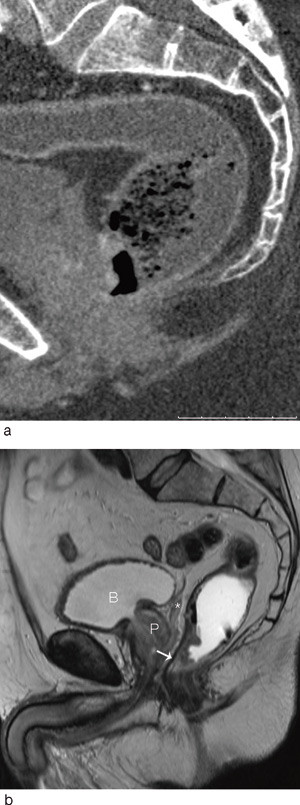 Figur 3  Multidetektor-CT-bilde rekonstruert i a) sagittal retning. b) Sagittal MR av helt distal rectumcancer. Det er&hellip;